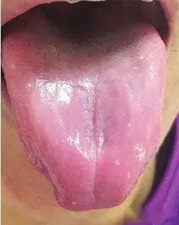Tongue Shape in TCM Tongue Diagnosis