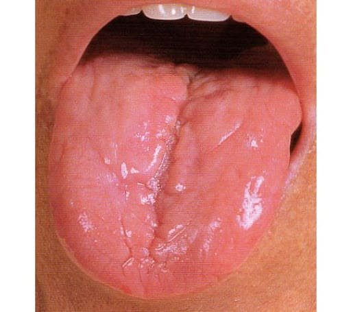 Tongue Shape in TCM Tongue Diagnosis