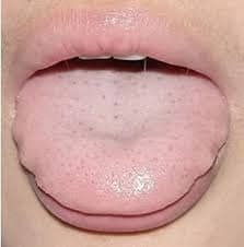 Tongue Shape in TCM Tongue Diagnosis