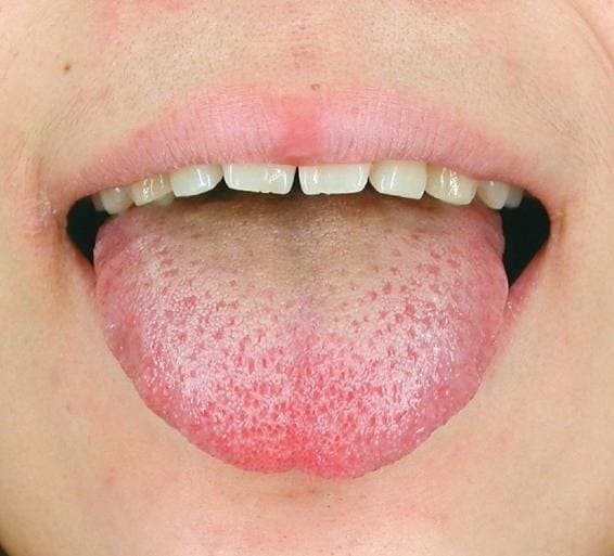 Tongue Shape in TCM Tongue Diagnosis