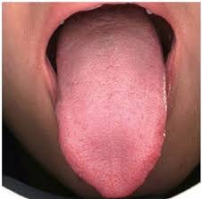 Tongue Shape in TCM Tongue Diagnosis