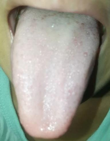 Tongue Shape in TCM Tongue Diagnosis