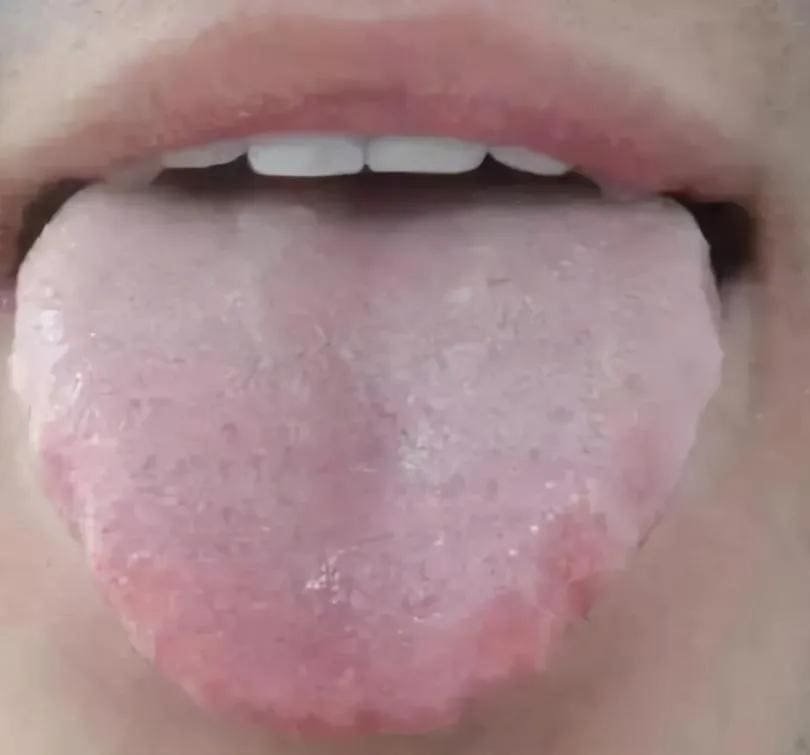 Tongue Shape in TCM Tongue Diagnosis