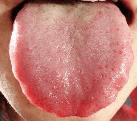 Tongue Shape in TCM Tongue Diagnosis