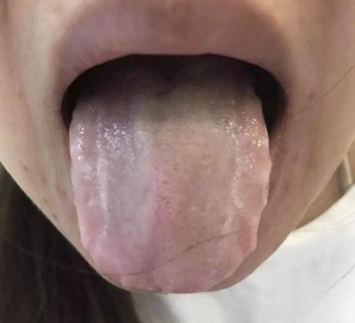 Tongue Shape in TCM Tongue Diagnosis