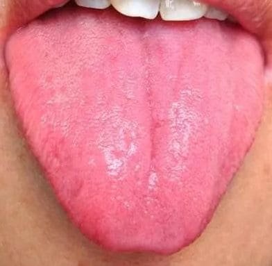 Tongue Shape in TCM Tongue Diagnosis