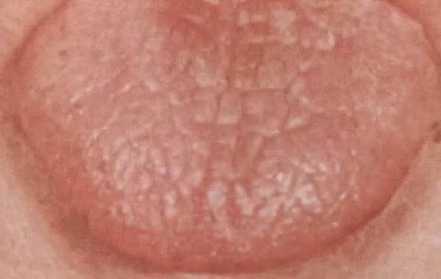 Tongue Shape in TCM Tongue Diagnosis