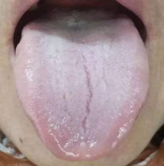 Tongue Shape in TCM Tongue Diagnosis