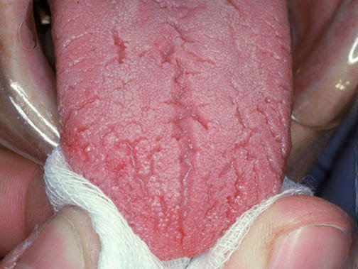 Tongue Shape in TCM Tongue Diagnosis