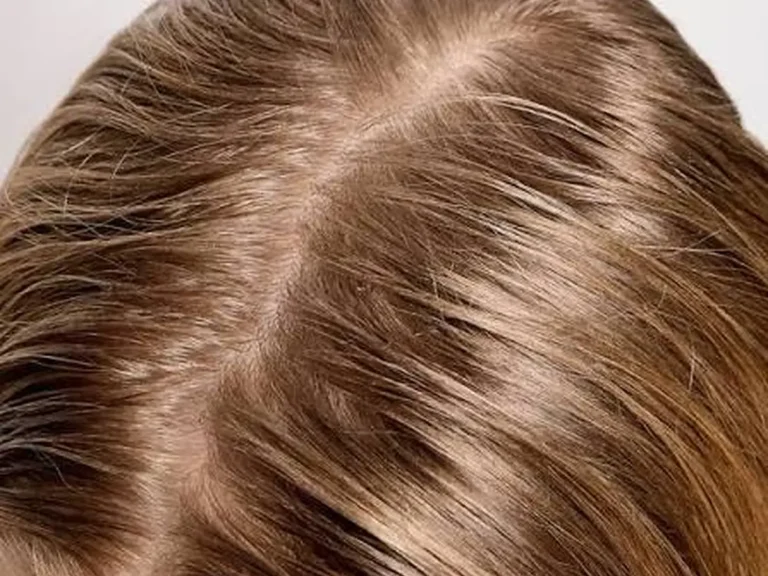 05-Scalp-Gets-Oily-Quickly.webp