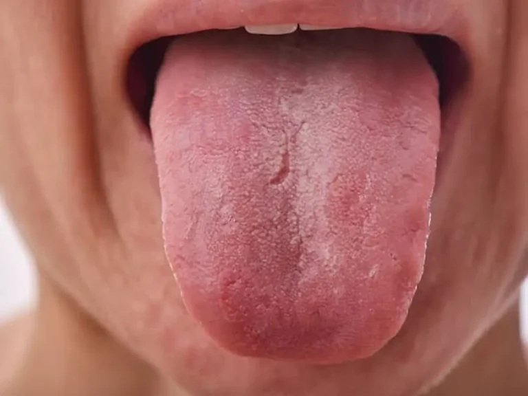 09-Tongue-Coating-Looks-Thick.webp