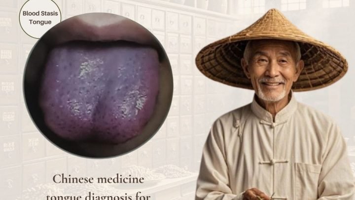 10 Blood Stasis Symptoms in Chinese Medicine Tongue Diagnosis -Blood Stasis